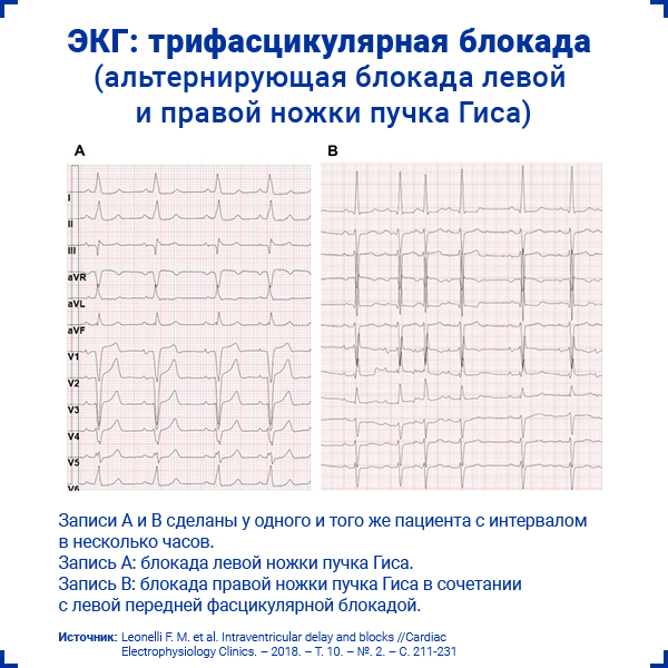 ЭКГ трифасцикулярная блокада альтернирующая блокада левой и правой ножки пучка Гиса